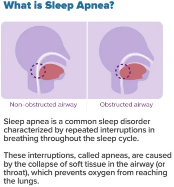 what is sleep apnea v2