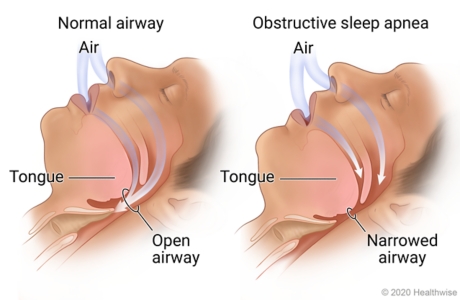 sleep apnea 1